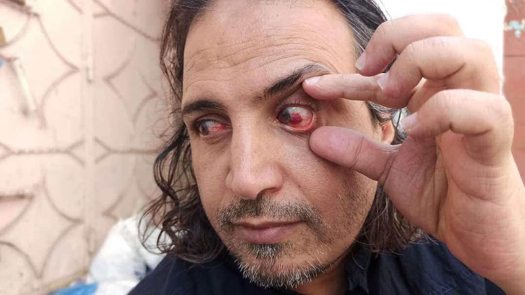 إصابة رسام يمني شهير في عينه.. في المستشفى اكتشف كارثة بسبب انتشار هذا الشيء بين الأطفال