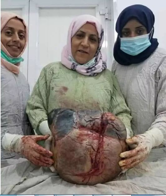 تفاصيل انجاز طبي في صنعاء باستئصال ورم خطير