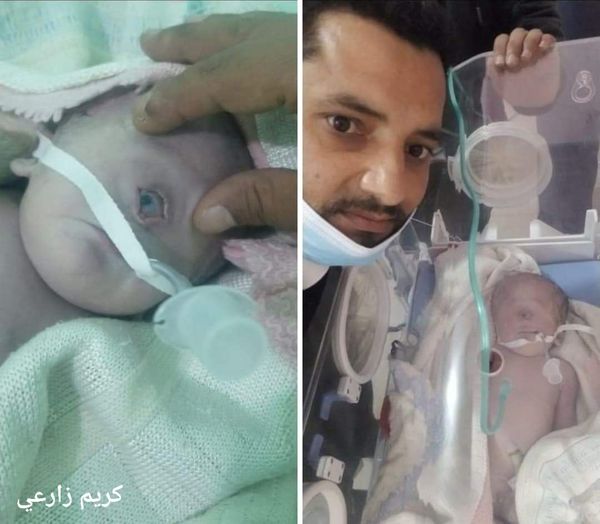 ولادة طفل بعين واحده في رداع بالبيضاء